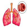 Побороть приступ бронхиальной астмы!