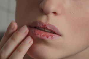 Почему сохнут губы и как бороться с этим недугом